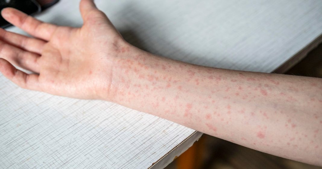 Measles cases in the U.S. hit 1,288, the highest recorded in more than 30 years